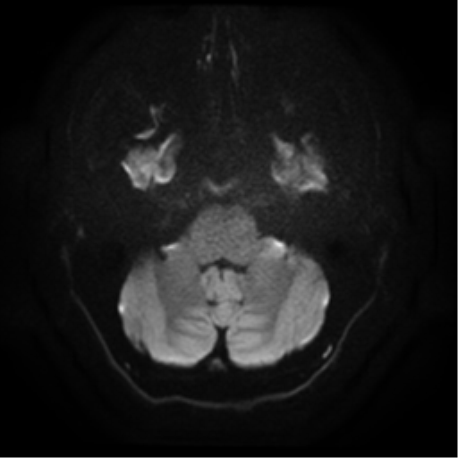 File:Cerebral abscess (Radiopaedia 57774-64740 Axial DWI 5).png