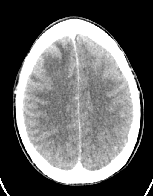 Cerebral abscess (Radiopaedia 60342-68008 Axial C+ delayed 37).png