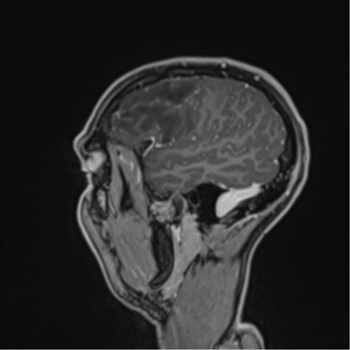 Cerebral abscess (Radiopaedia 60342-68009 J 46).png