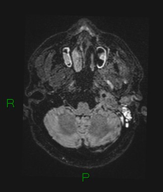 Cerebral abscess and subdural empyema (Radiopaedia 84436-99779 Axial FLAIR 69).jpg