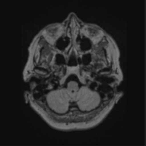 Cerebral abscess from pulmonary arteriovenous malformation (Radiopaedia 86275-102291 J 16).png