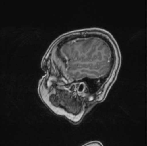 Cerebral abscess from pulmonary arteriovenous malformation (Radiopaedia 86275-102291 Sagittal T1 C+ 67).png