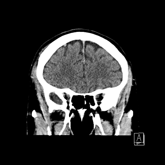 File:Cerebral abscess with ventriculitis (Radiopaedia 78965-91877 B 16).jpg