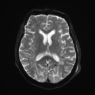 Cerebral amyloid angiopathy-related inflammation (Radiopaedia 74836-85849 Axial DWI 17).jpg