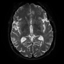 File:Cerebral amyloid angiopathy (Radiopaedia 28698-28978 Axial DWI 42).jpg