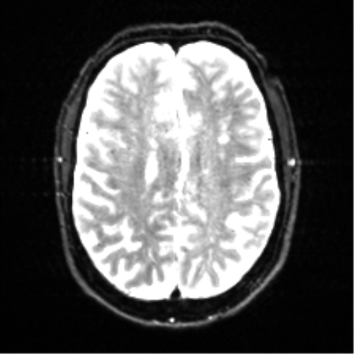 Cerebral amyloid angiopathy (Radiopaedia 46082-50433 Axial DWI 18).png