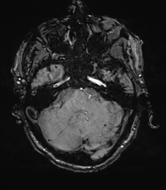 File:Cerebral amyloid angiopathy (Radiopaedia 46082-50433 Axial SWI 19).png