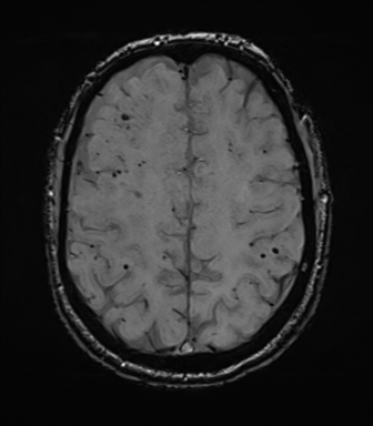 Cerebral amyloid angiopathy (Radiopaedia 46082-50433 Axial SWI 61).png