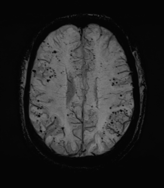 Cerebral amyloid angiopathy (Radiopaedia 46082-50433 Axial SWI MIP 54).png