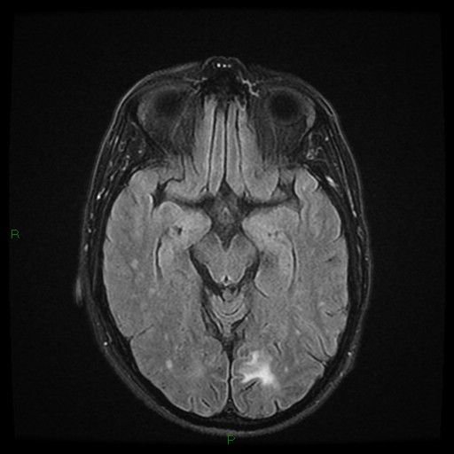 File:Cerebral amyloid angiopathy (Radiopaedia 77506-89664 Axial FLAIR 12).jpg