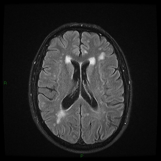 File:Cerebral amyloid angiopathy (Radiopaedia 77506-89664 Axial FLAIR 17).jpg