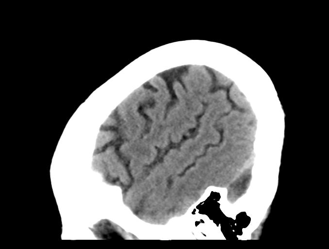 File:Cerebral aneurysm with rupture (Radiopaedia 29933-30457 B 6).jpg