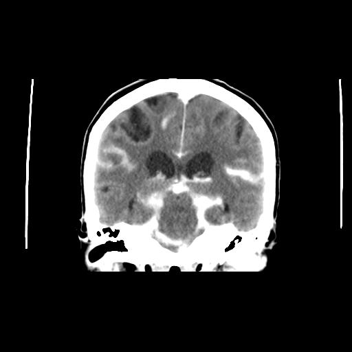 File:Cerebral aneurysm with rupture (Radiopaedia 29933-30460 Axial non-contrast 1).jpg