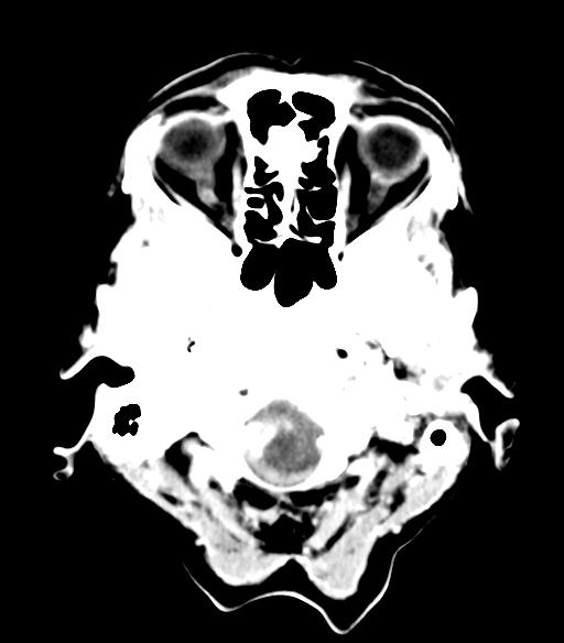 File:Cerebral aneurysm with rupture (Radiopaedia 29933-30460 Axial non-contrast 3).jpg