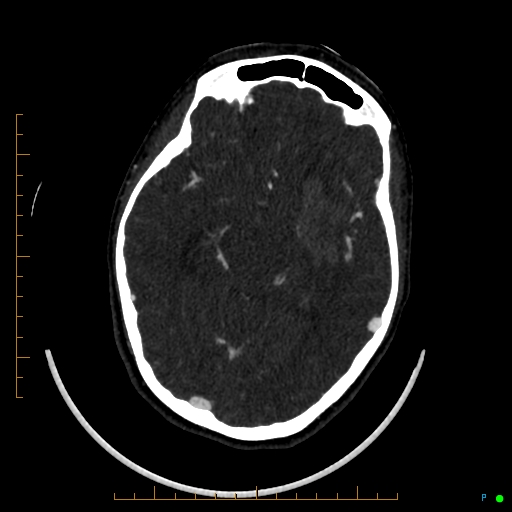 Cerebral arteriovenous malformation (AVM) (Radiopaedia 78162-90706 Axial CTA 127).jpg