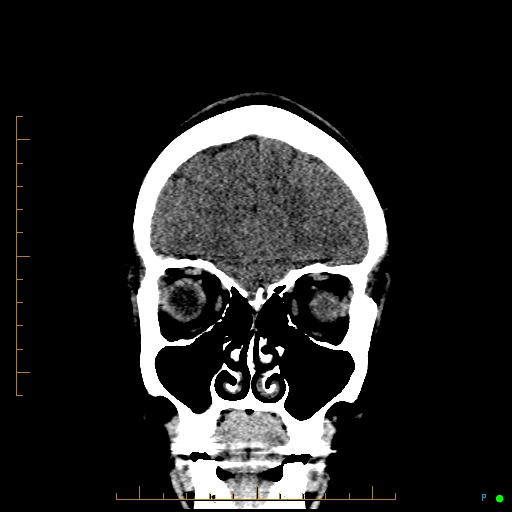 Cerebral arteriovenous malformation (AVM) (Radiopaedia 78162-90706 Coronal non-contrast 21).jpg