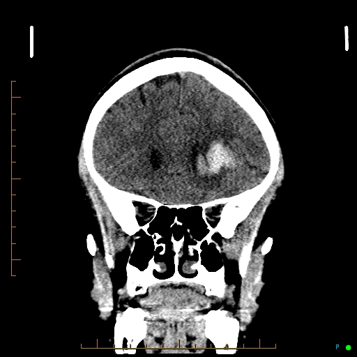 Cerebral arteriovenous malformation (AVM) (Radiopaedia 78162-90706 Coronal non-contrast 31).jpg