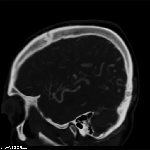 Cerebral arteriovenous malformation (Radiopaedia 28518-28759 D 57).jpg