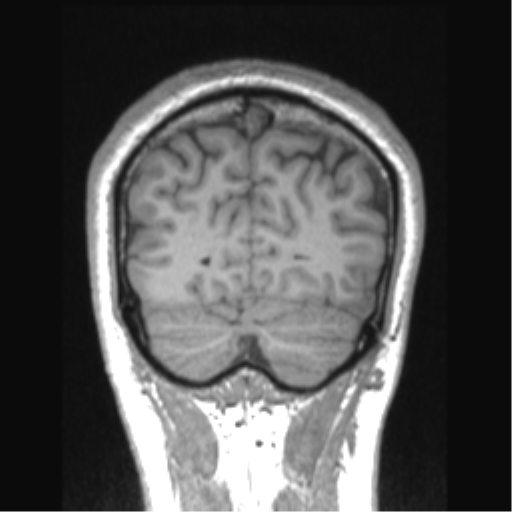 Cerebral arteriovenous malformation (Radiopaedia 39259-41506 Coronal T1 19).png
