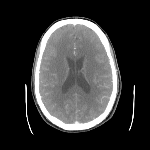 Cerebral arteriovenous malformation (Radiopaedia 55798-62371 B 31).png