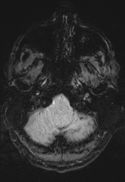 File:Cerebral arteriovenous malformation (Radiopaedia 55798-62372 Axial SWI 4).png