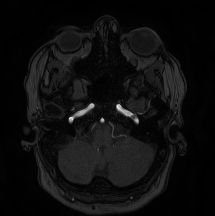 Cerebral arteriovenous malformation (Radiopaedia 74411-85654 Axial MRA 11).jpg