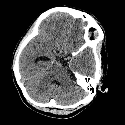 File:Cerebral arteriovenous malformation (Radiopaedia 79677-92887 Axial non-contrast 9).jpg