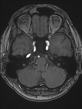 Cerebral arteriovenous malformation (Radiopaedia 84015-99245 Axial TOF 75).jpg
