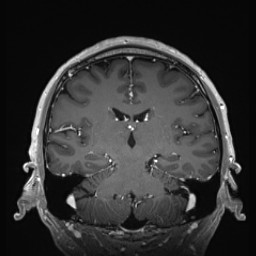 Cerebral arteriovenous malformation (Radiopaedia 84015-99245 Coronal T1 C+ 92).jpg