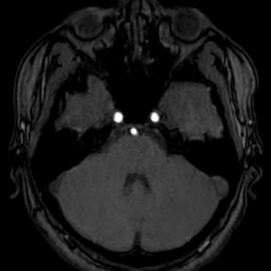 Cerebral arteriovenous malformation at posterior body of corpus callosum (Radiopaedia 74111-84925 Axial MRA 47).jpg