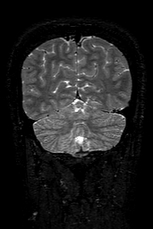 Cerebral arteriovenous malformation at posterior body of corpus callosum (Radiopaedia 74111-84925 Coronal T2 145).jpg