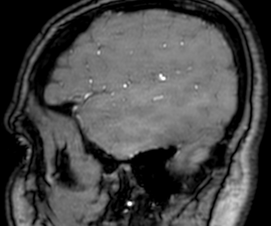 Cerebral arteriovenous malformation at posterior body of corpus callosum (Radiopaedia 74111-84925 J 350).jpg