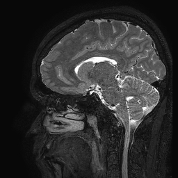 Cerebral arteriovenous malformation at posterior body of corpus callosum (Radiopaedia 74111-84925 Sagittal T2 55).jpg
