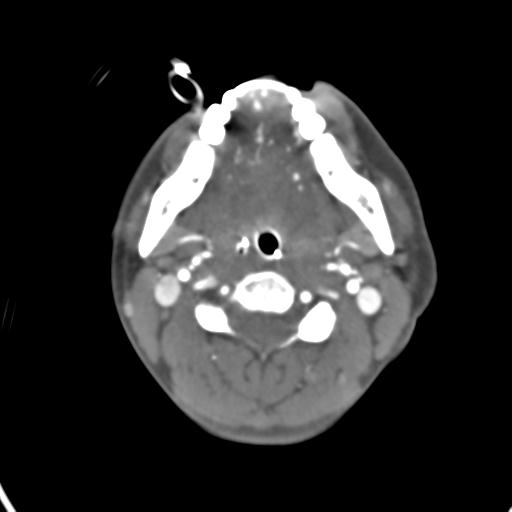Cerebral arteriovenous malformation with hemorrhage (Radiopaedia 28773-29073 A 65).jpg