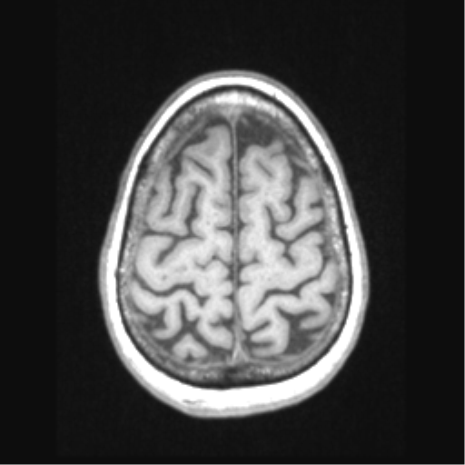 Cerebral arteriovenous malformation with hemorrhage (Radiopaedia 34422-35737 Axial T1 64).png