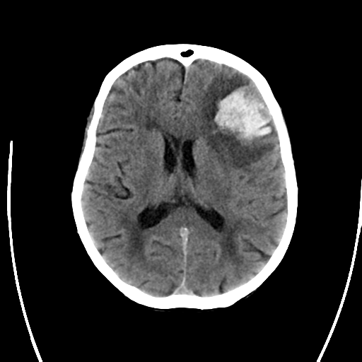 File:Cerebral arteriovenous malformation with lobar hemorrhage (Radiopaedia 44725-48512 Axial non-contrast 21).png