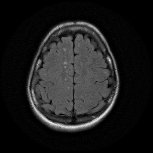 File:Cerebral autosomal dominant arteriopathy with subcortical infarcts and leukoencephalopathy (CADASIL) (Radiopaedia 41018-43763 Ax T2 Flair PROP 16).png