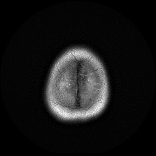 File:Cerebral autosomal dominant arteriopathy with subcortical infarcts and leukoencephalopathy (CADASIL) (Radiopaedia 41018-43768 AX FLAIR (Propeller) 20).png