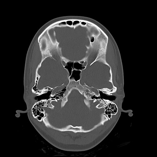 Cerebral cavernous venous malformation (Radiopaedia 70008-80022 Axial bone window 8).jpg