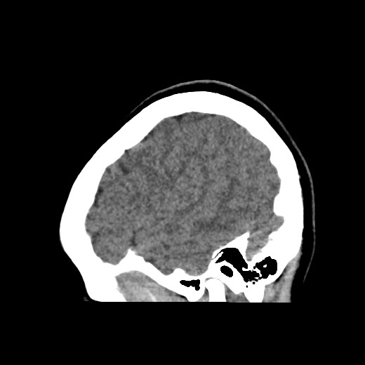 Cerebral cavernous venous malformation (Radiopaedia 70008-80022 C 10).jpg