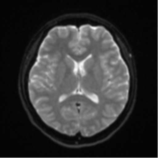 Cerebral cavernous venous malformations (Radiopaedia 48117-52946 Axial DWI 15).png