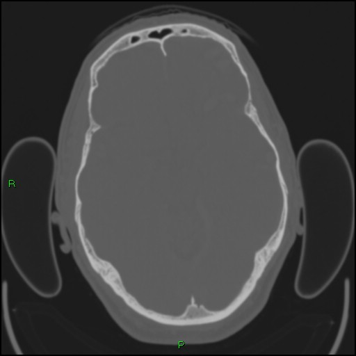 Cerebral contusions (Radiopaedia 33868-35039 Axial bone window 82).jpg