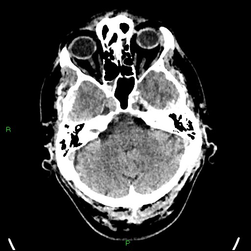 Cerebral contusions (Radiopaedia 33868-35039 Axial non-contrast 48).jpg