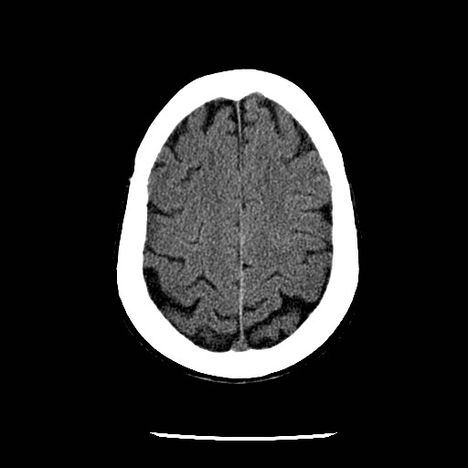 File:Cerebral edema (evolution in time) (Radiopaedia 19418-19441 non-contrast 74).jpg