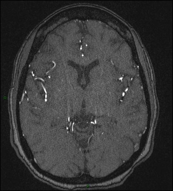 Cerebral fat embolism (Radiopaedia 35022-36525 Axial TOF 102).jpg