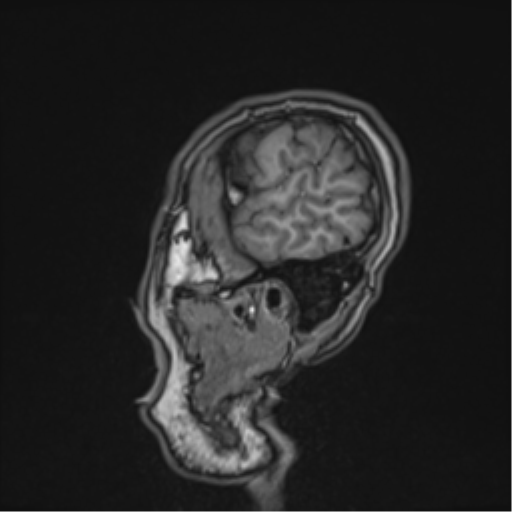 Cerebral fat embolism (Radiopaedia 57697-64639 Sagittal T1 42).png