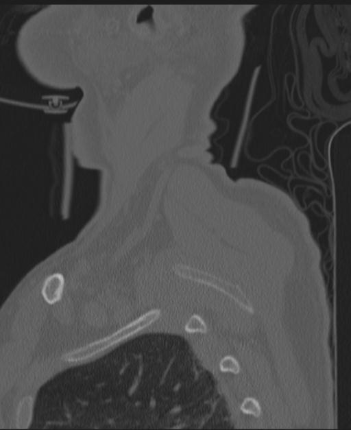 Cerebral hemorrhagic contusions and cervical spine fractures (Radiopaedia 32865-33841 Sagittal bone window 4).jpg