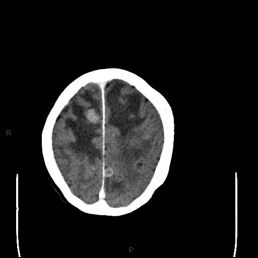 Cerebral metastases - breast primary (Radiopaedia 77653-89857 Axial C+ delayed 92).jpg
