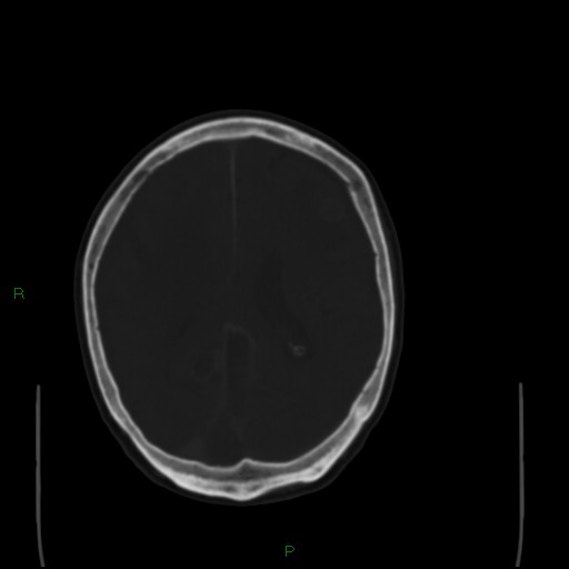 Cerebral metastases - breast primary (Radiopaedia 77653-89857 Axial bone window 73).jpg