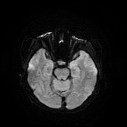 Cerebral metastases - melanoma (Radiopaedia 80972-94522 Axial DWI 12).jpg